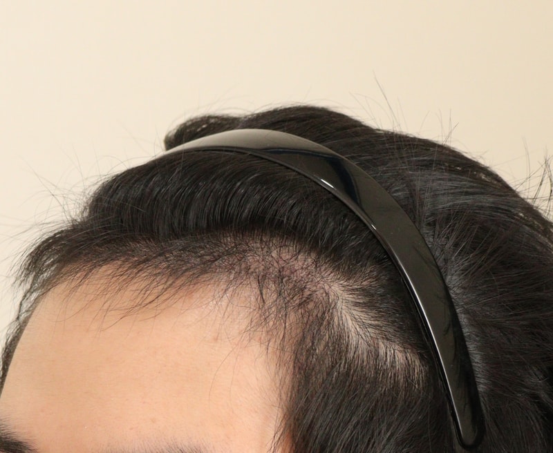 4. 수술후_6개월_3.JPG