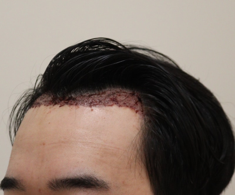 2. 수술후_1일_2.JPG