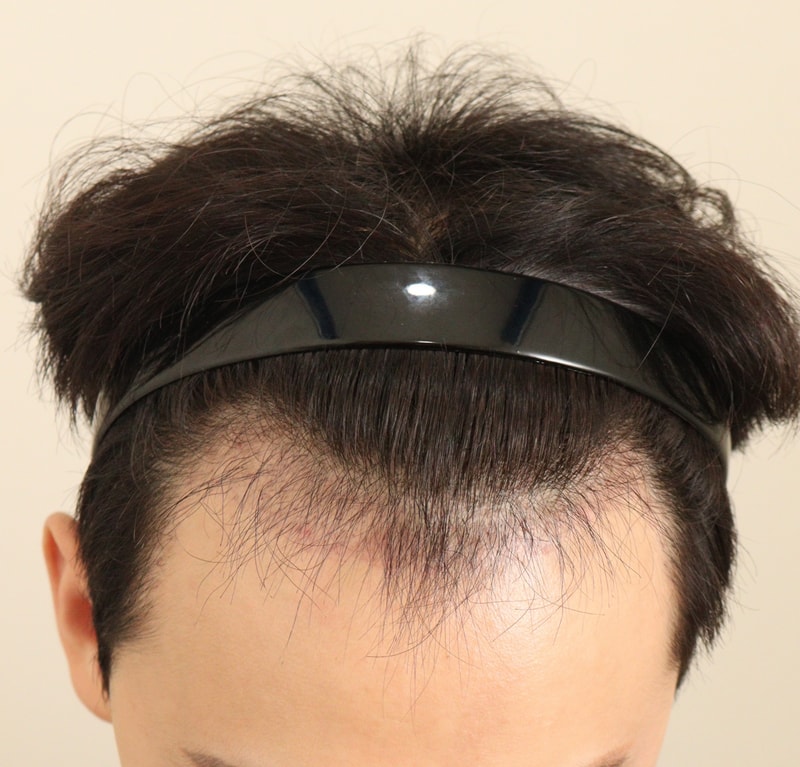 3. 수술후_3개월_1.JPG