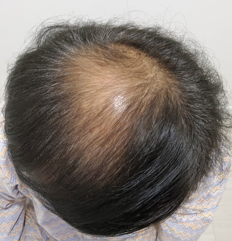 두피 문신보다는 모발이식이 좋네요^^