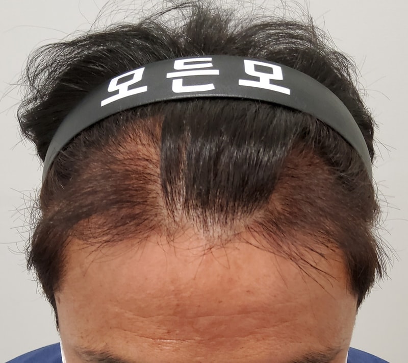 3. 수술후_3개월_1.jpg