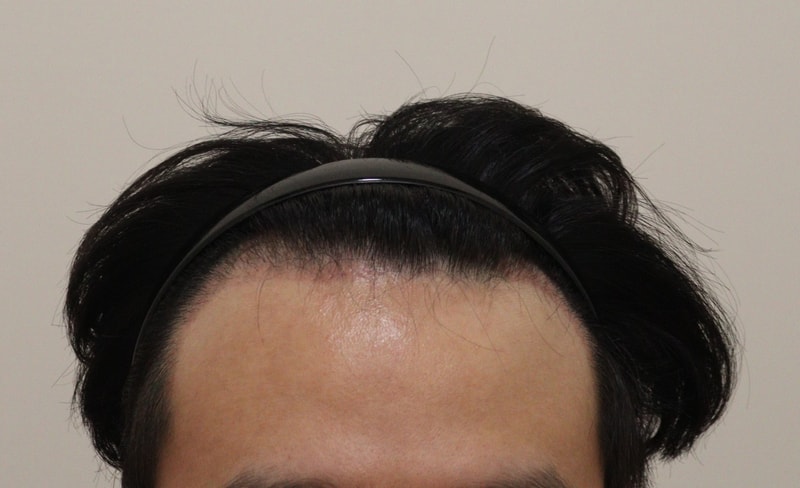 2. 수술후_3개월_1.JPG