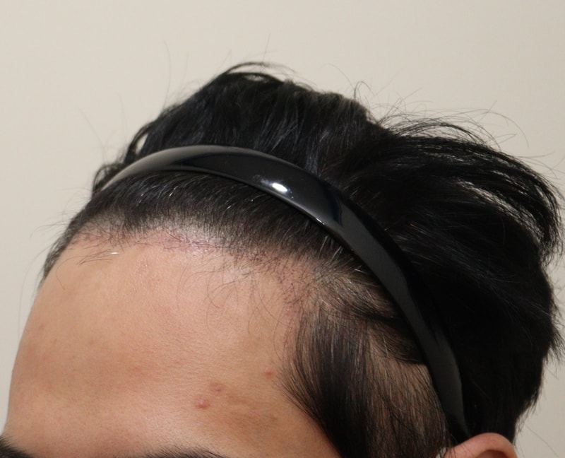 3. 수술후_1개월_3.JPG