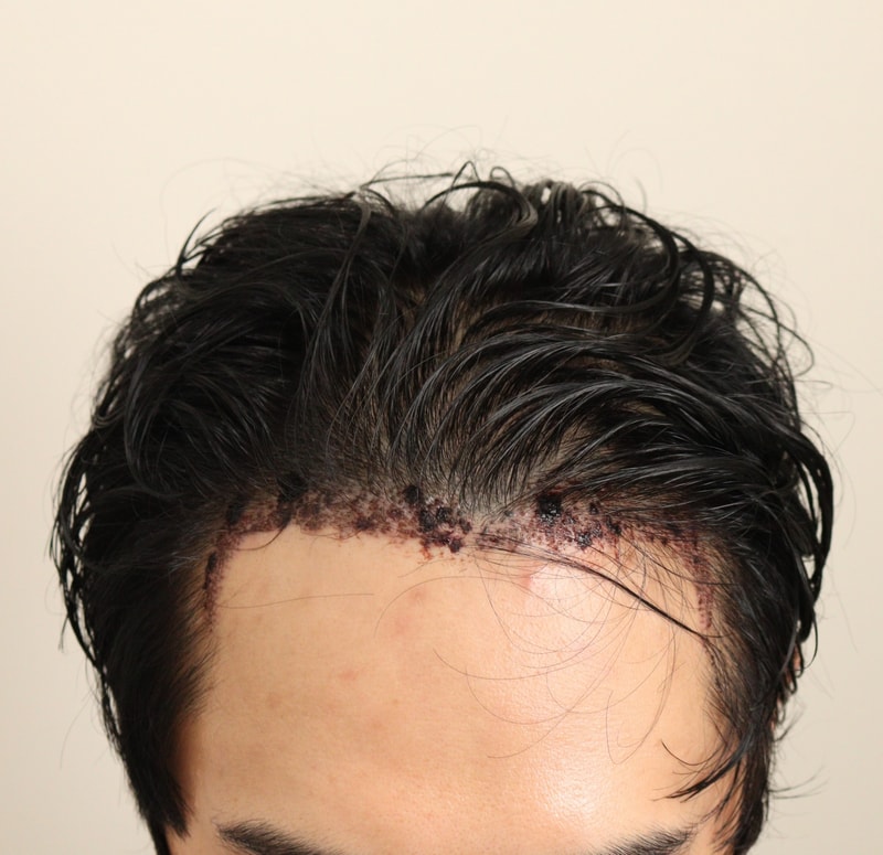 2. 수술후_1일.JPG