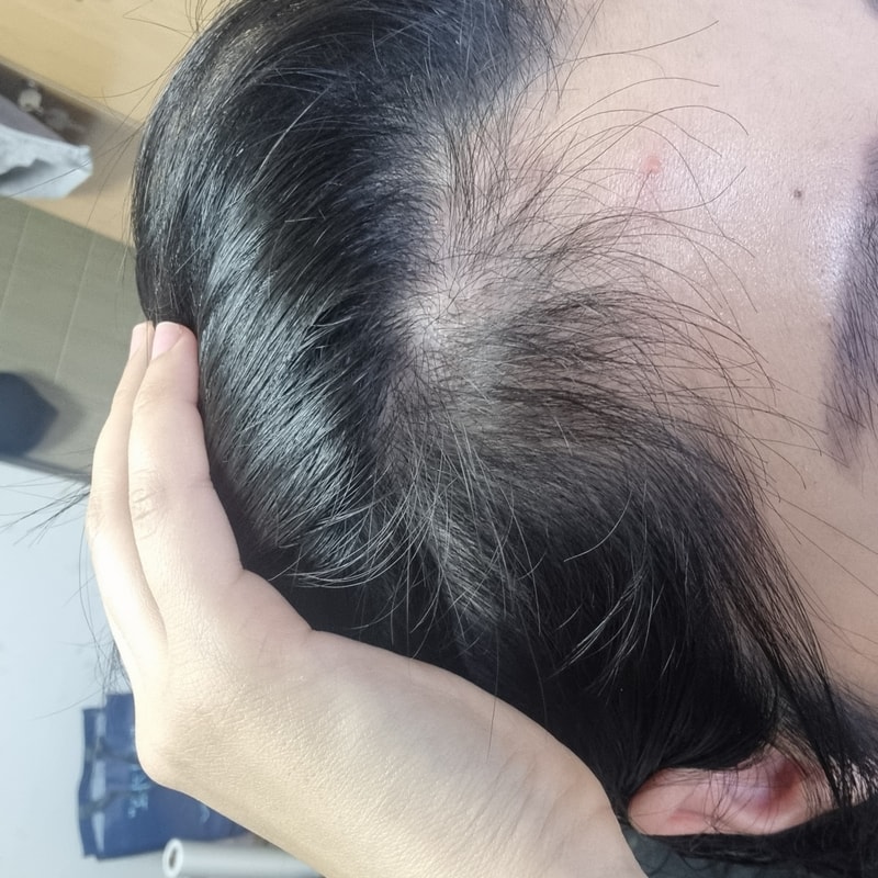 3. 수술후_3개월_셀카_3.jpg