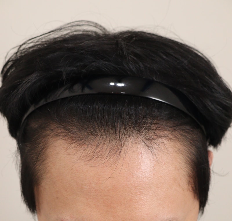 넓은이마 이식한지 육개월 달성했습니다!