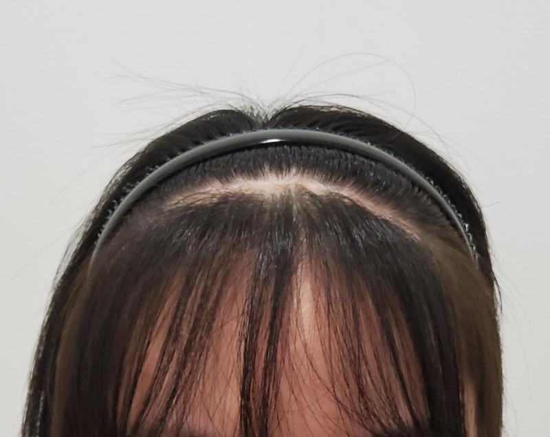 I solved it with old surgical scars, hair transplants!