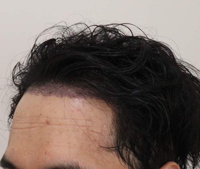 2. 수술후_1일_2.JPG