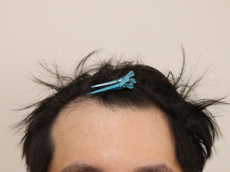 비절개 5개월차 후기입니다