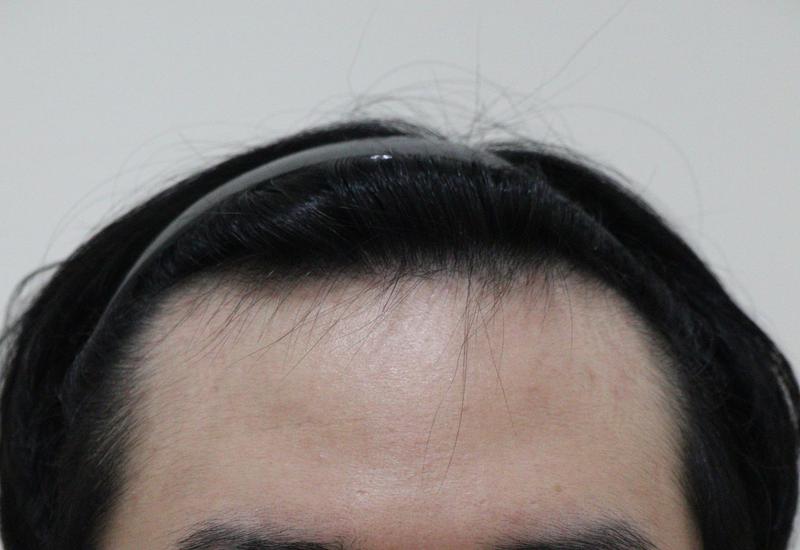 悩んでいたヘアラインの毛髪移植を受けました~