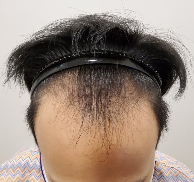 1. 수술전_1.jpg