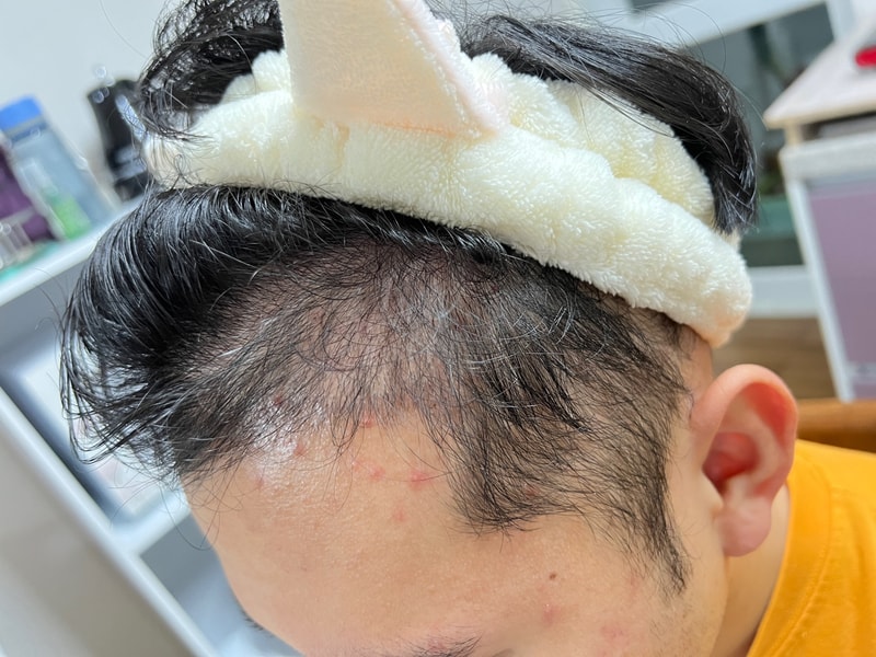 2. 수술후_3개월_셀카2.jpg