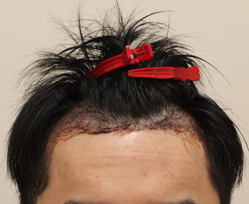 2. 수술후_1일.JPG