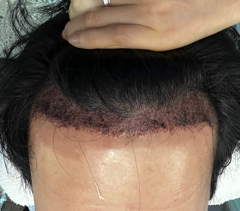 2. 수술후_1일_1.jpg