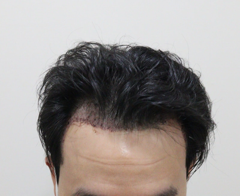 1. 수술후_1일_1.JPG
