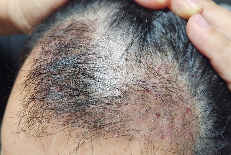 3. 수술후_3개월_셀카_2.jpg