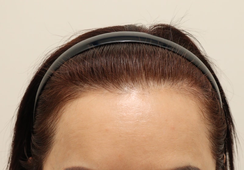 벌써 일년이네요 여자 헤어라인 후기입니다~