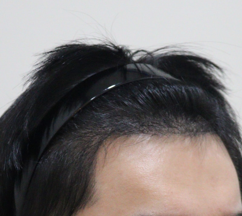 4. 수술후_6개월_3.JPG