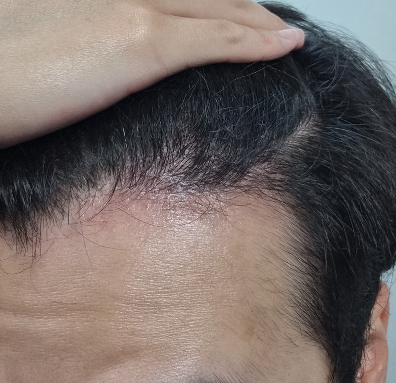 4. 수술후_6개월_셀카1.jpg