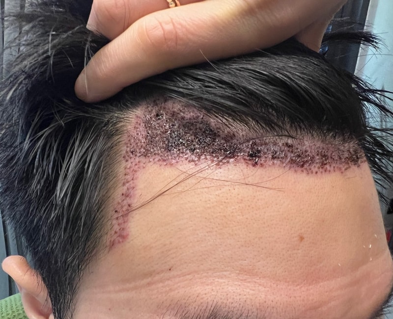 2. 수술후_1일_3.jpg