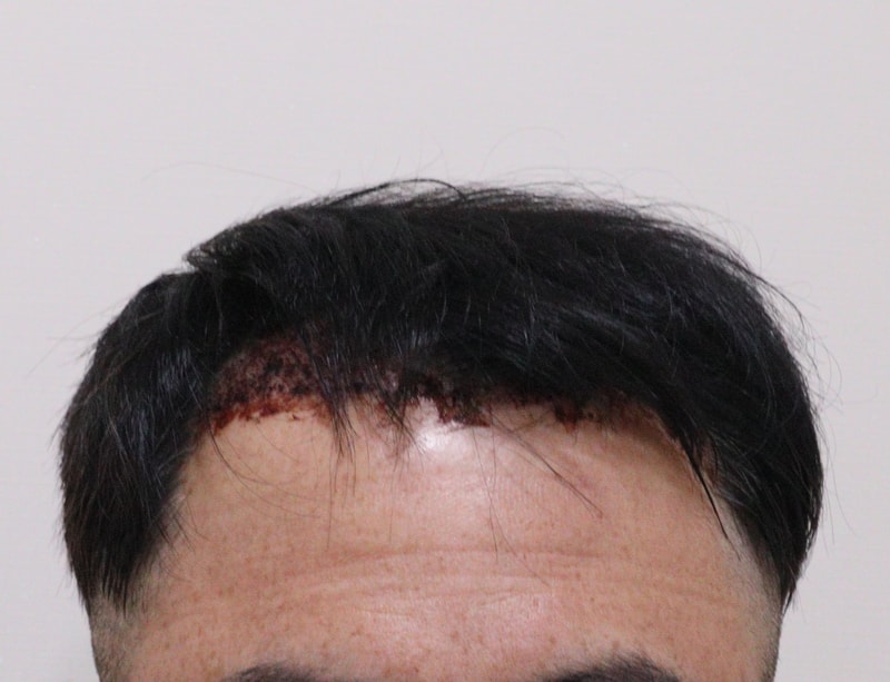 2. 수술후_1일_1.JPG