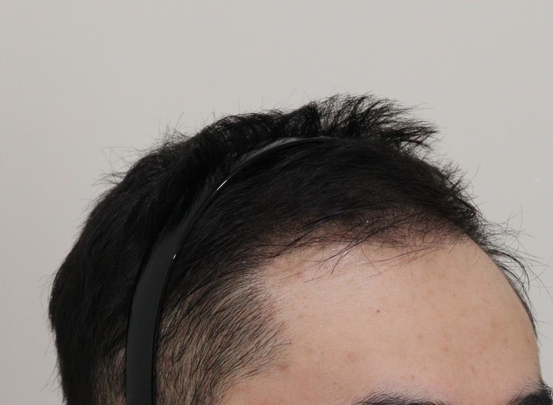 3. 수술후_3개월_3.JPG