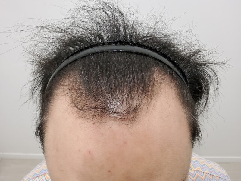 모발이식으로 인상 개선하기 1일차