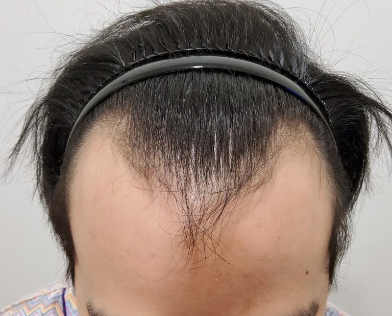 모발이식 성공이네요 일년입니다!