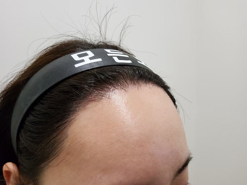 5. 수술후_1년후_2.jpg