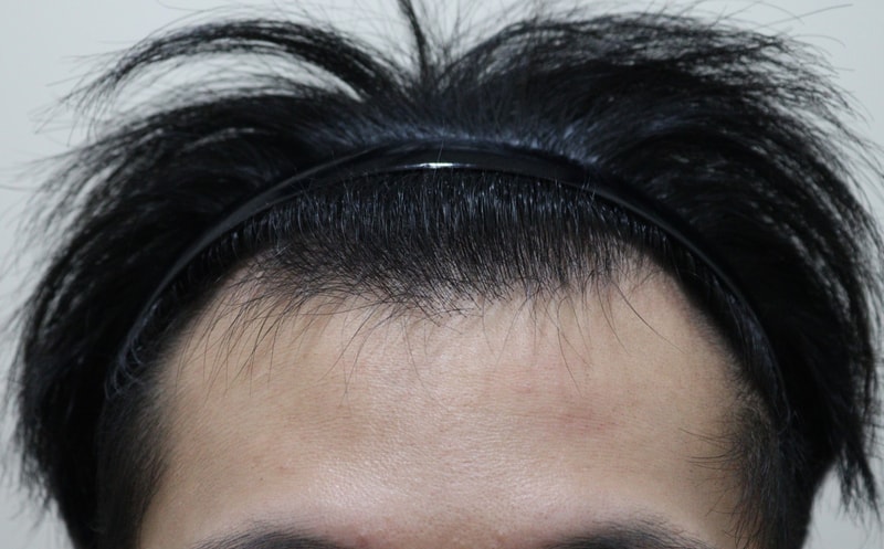 비절개로 2100모 이식했어요