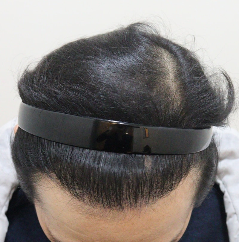 4. 수술후_1년_2.JPG