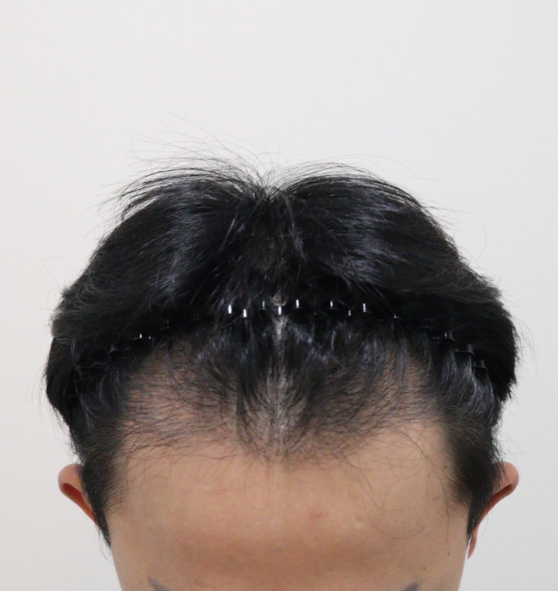 0. 수술전_2.JPG