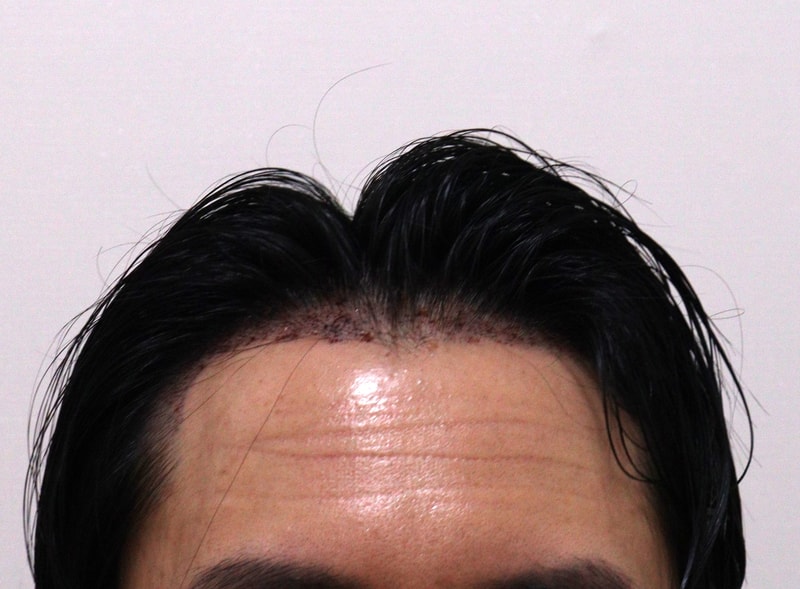 2. 수술후_1일_1.JPG