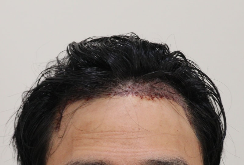 2. 수술후_1일_1.JPG