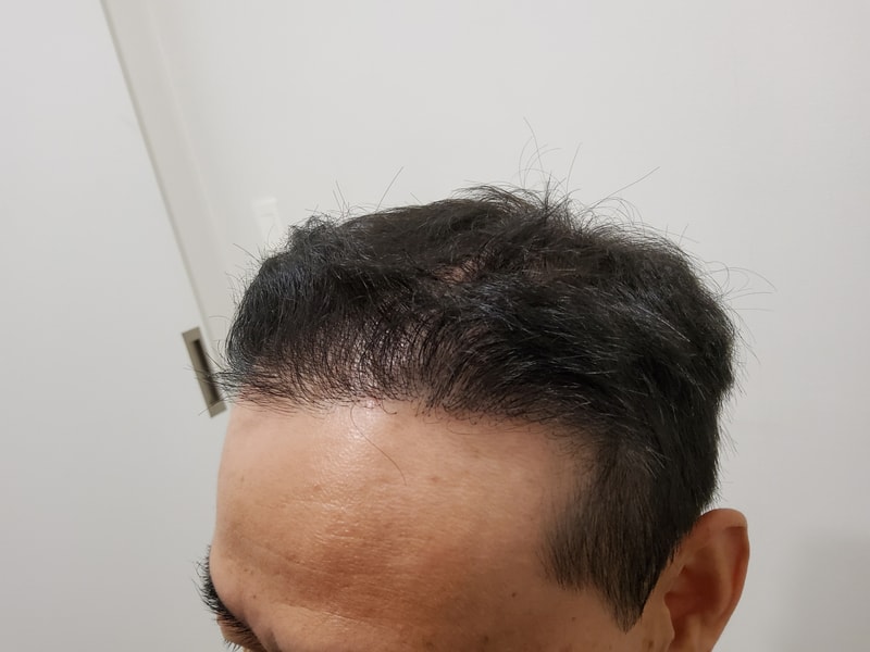 수술후_1년_3.jpg