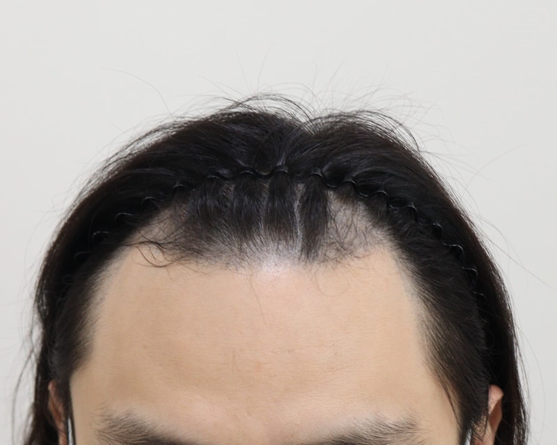 두피문신도 소용없어서 모발이식 했습니다