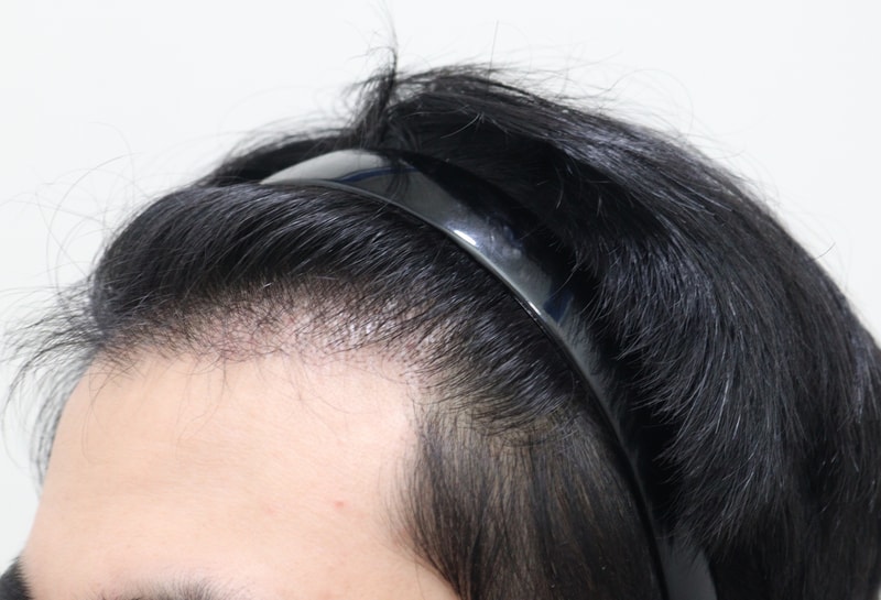 2. 수술후_7개월_2.JPG