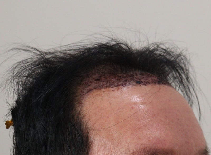 2. 수술후_1일_4.JPG