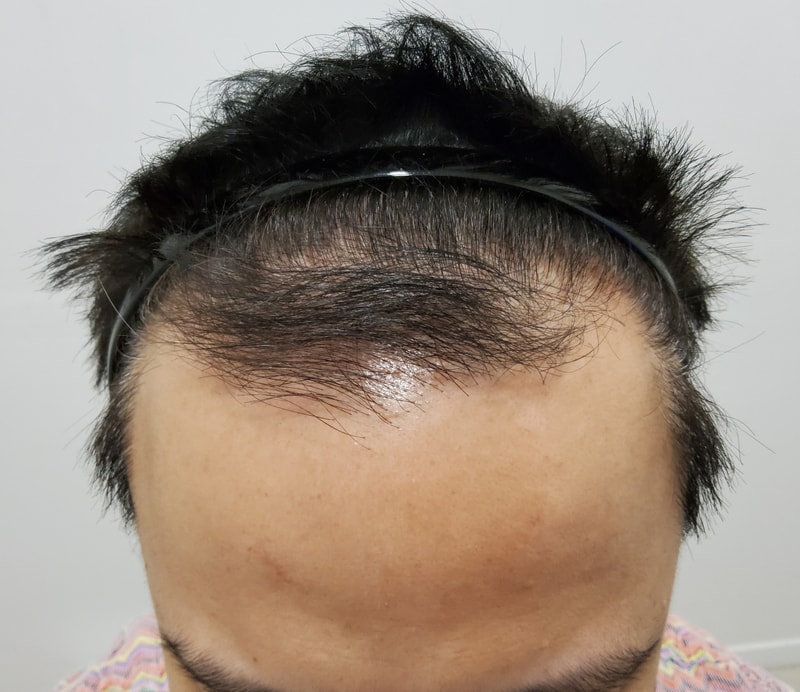 0. 수술전_1.jpg