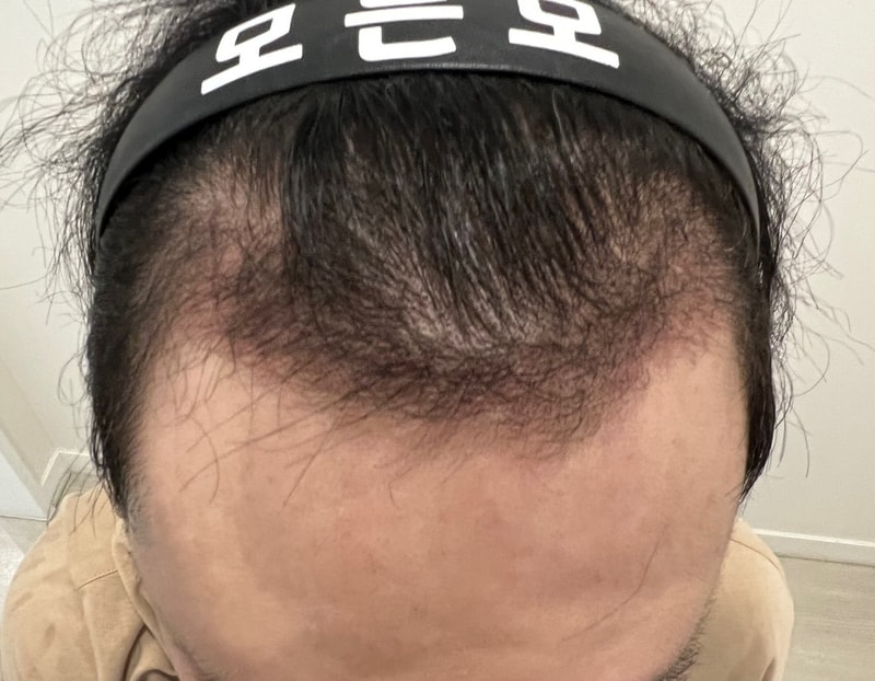 3. 수술후_3개월_1.jpg