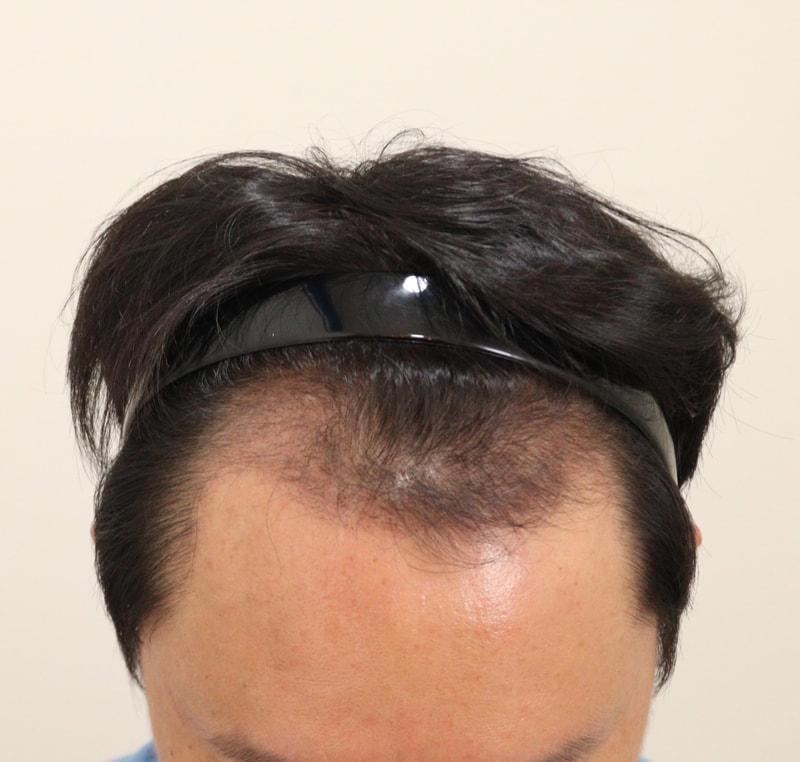 3. 수술후_3개월_1.JPG