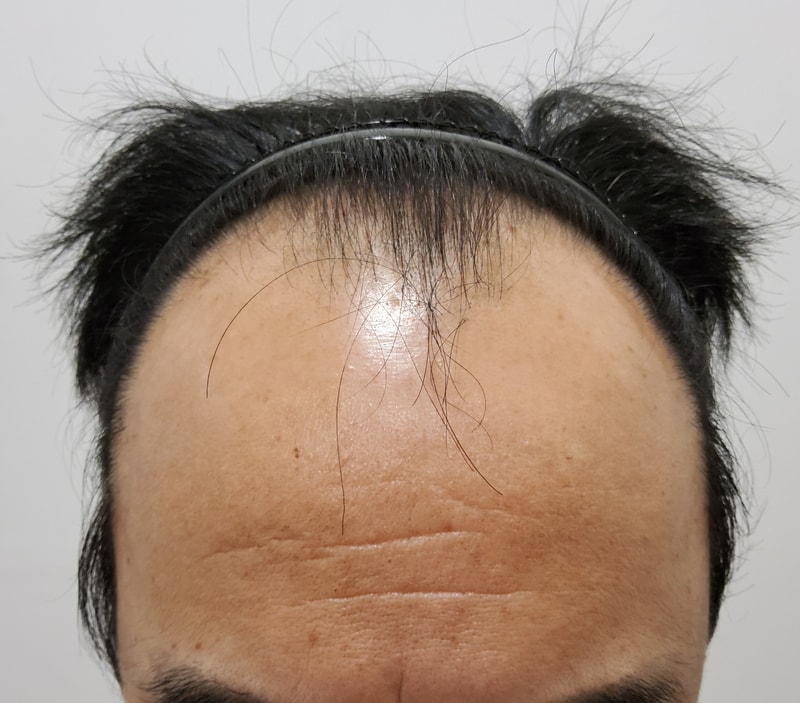 탈모가 심해서 모발이식 받았습니다