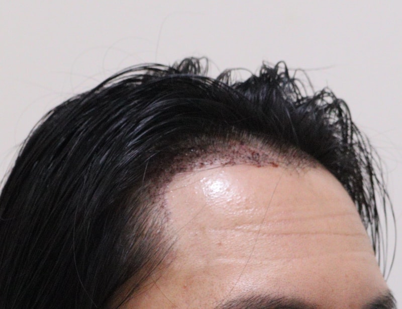 2. 수술후_1일_3.JPG