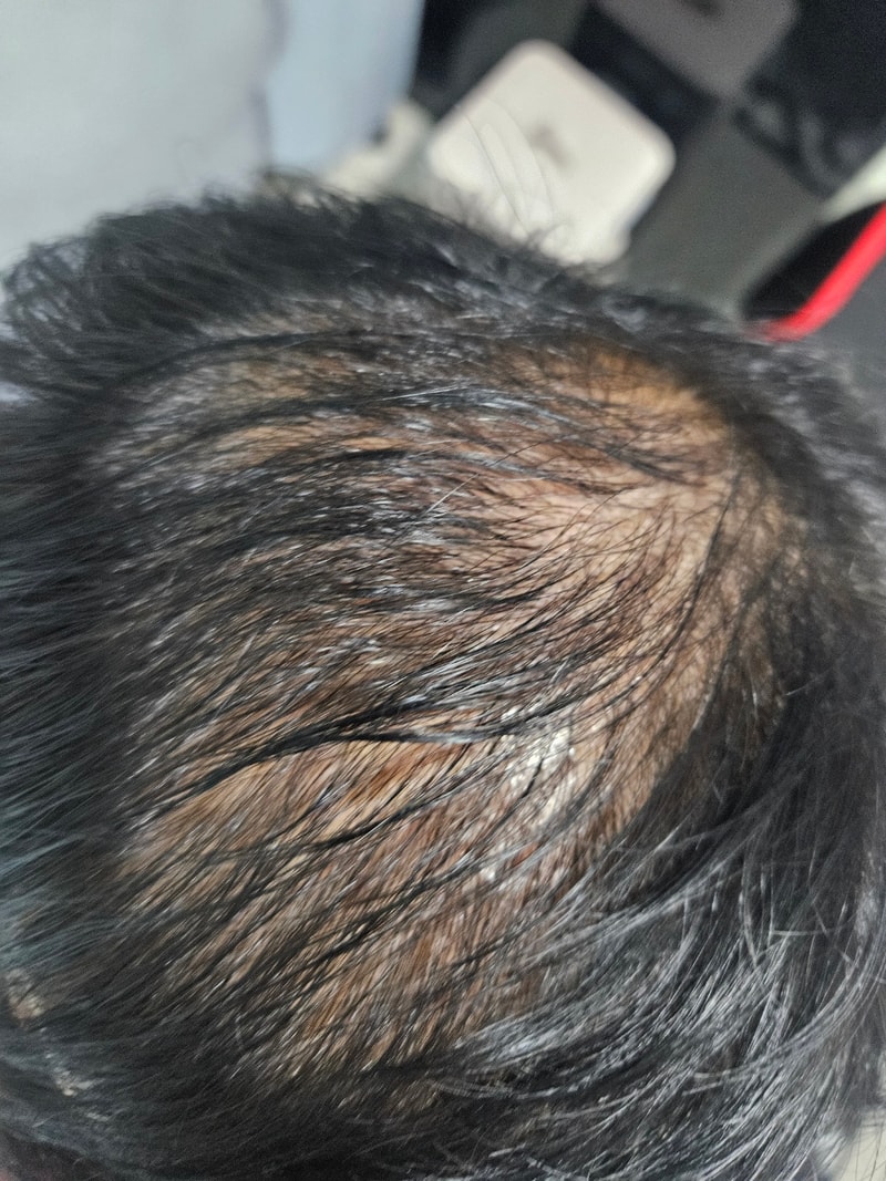 3. 수술후_3개월_셀카.jpg