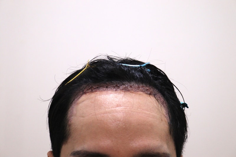 2. 수술후_1일_1.JPG