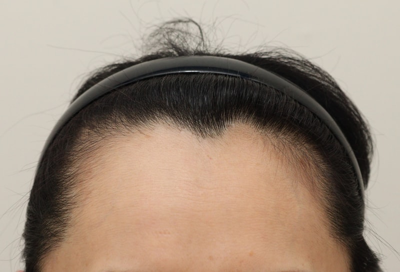 I'm sharing my review of the hair transplant for 3 months!