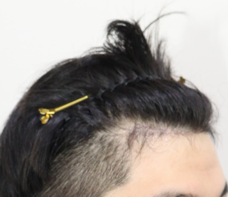 4. 수술후_5개월_3.JPG