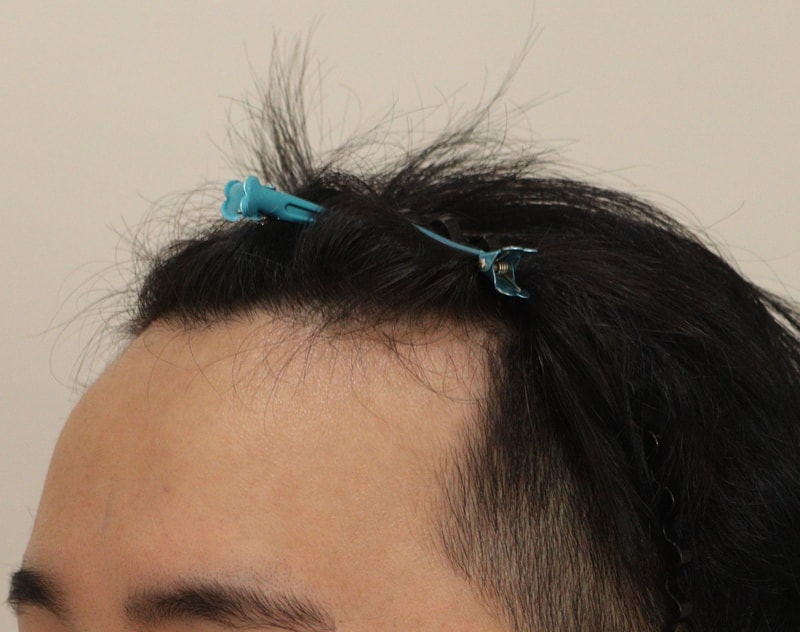 1. 수술전_2.JPG