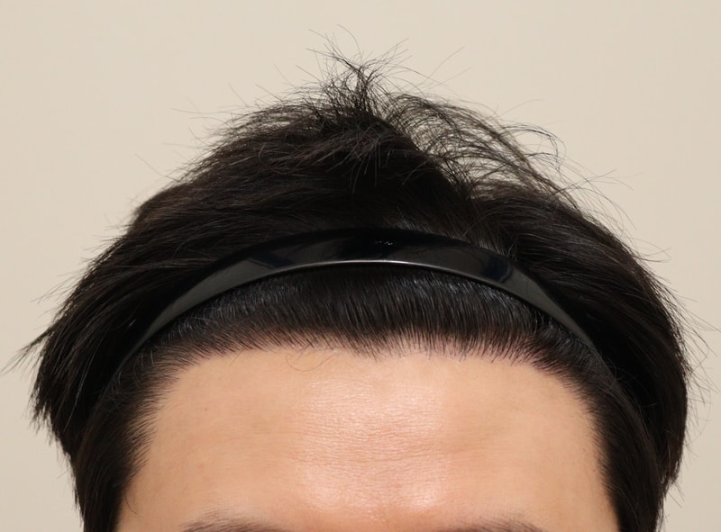 5. 수술후_1년_1.JPG