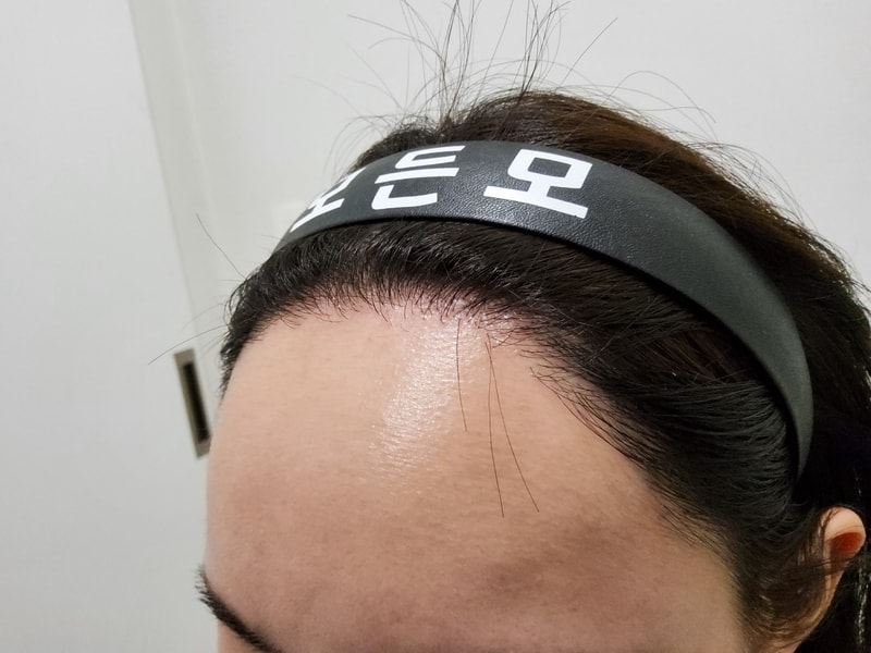 5. 수술후_1년후_3.jpg